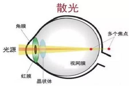 视力屈光不正是什么原因造成