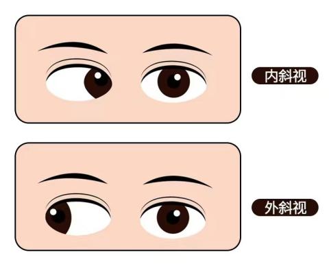 斜视矫正手术最佳年龄