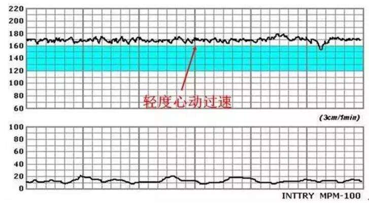 胎心监护图怎么看正常,胎心监护图解读指南，如何判断正常与进行精细评估,实地评估数据方案_Nexus20.35.80