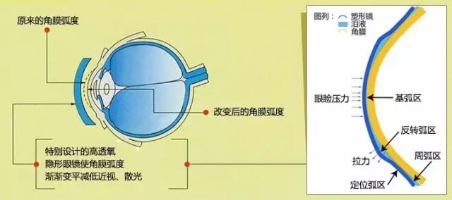 角膜塑形镜的价格大约在多少