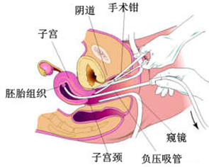 做完人流多久来月经从什么时候算起