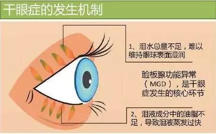 干眼症的治疗方法有哪些