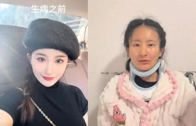 女生确诊渐冻症一年容貌巨变