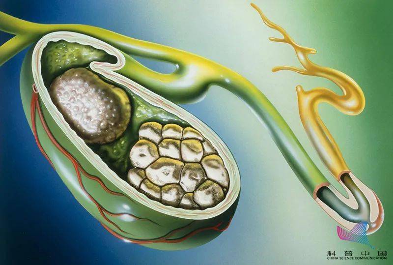 女子胆囊内竟藏400多颗结石