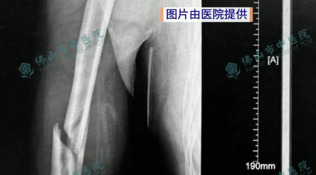 两小伙与机器人掰手腕当场骨折